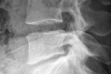 Röntgen Lendenwirbelsäule: Höhenminderung der untersten Bandscheibe als Zeichen der Degeneration